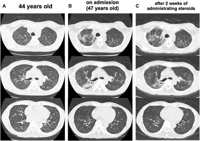 Case Report: Hereditary Fibrosing Poikiloderma With Tendon Contractures, Myopathy, and Pulmonary Fibrosis (POIKTMP) Presenting With Liver Cirrhosis and Steroid-Responsive Interstitial Pneumonia